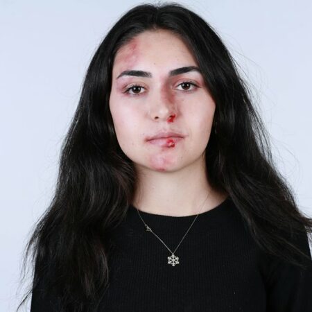 Yleiset baseball-vammat ja toipumisaikataulut